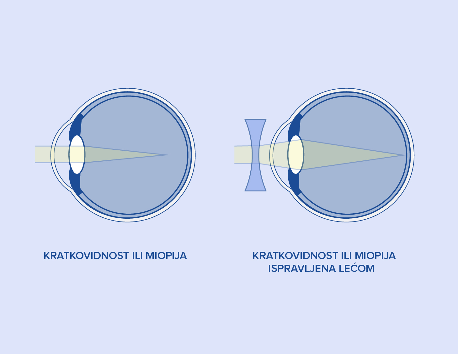 Kratkovidnost ili miopija