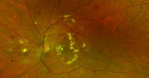 Dijabetička retinopatija i dijabetički makularni edem. Fotografija očne pozadine.