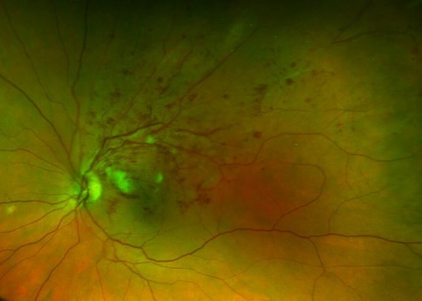 Okluzija ogranka središnje retinalne vene. Fotografija očne pozadine.